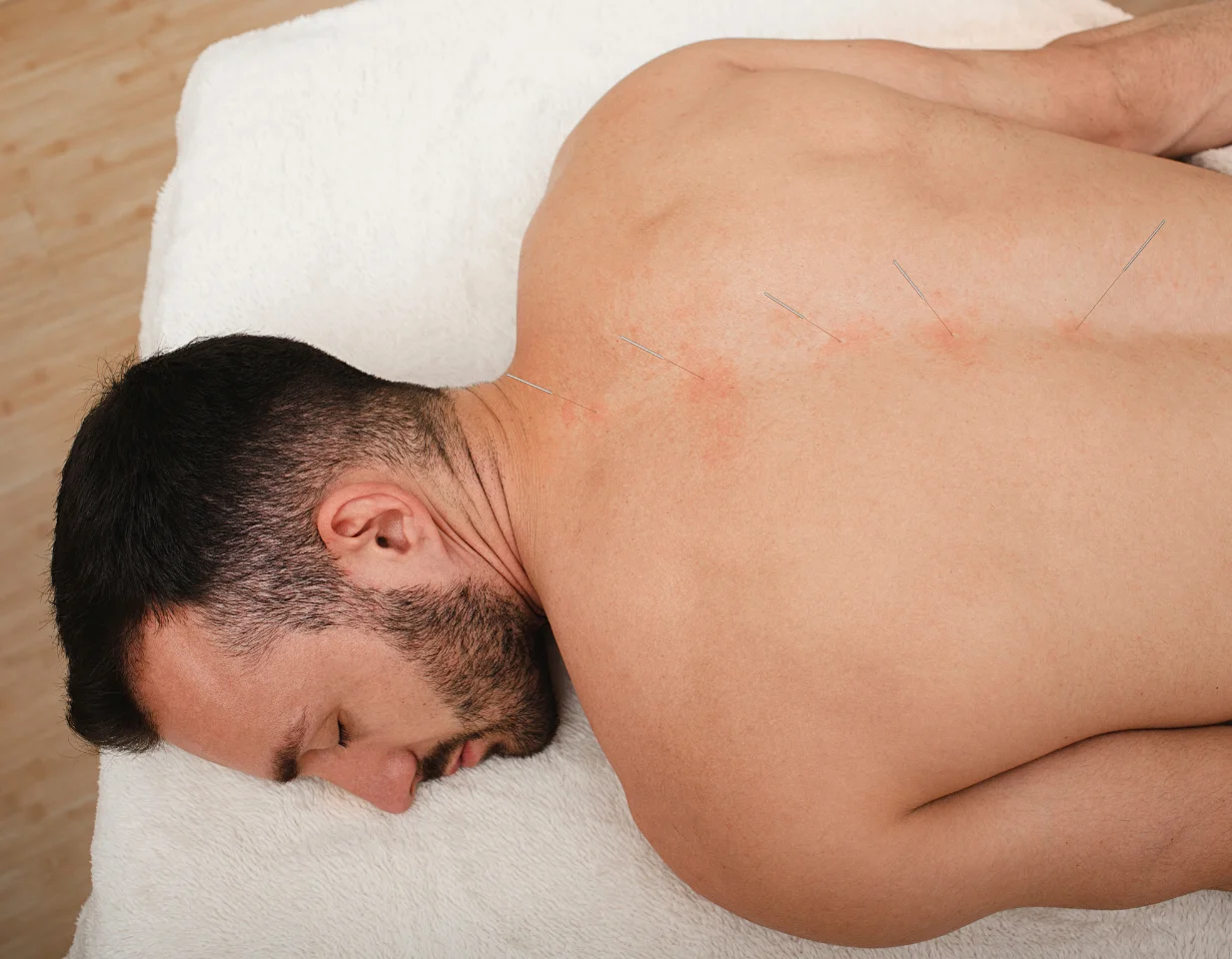 Acupuncture Physical Therapy
